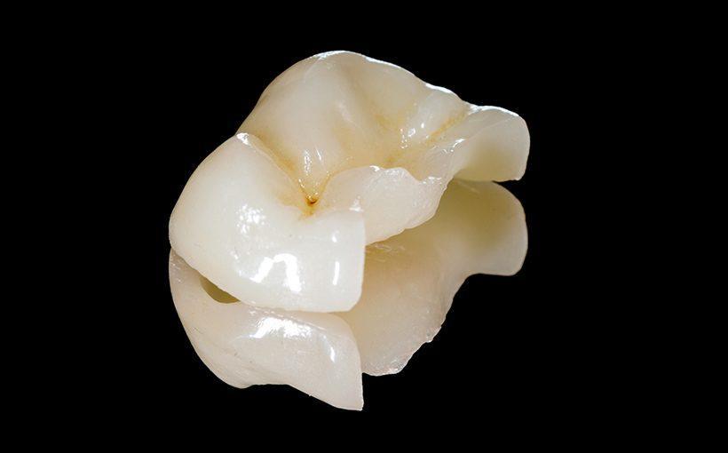 ¿Incrustación dental o corona? • Centro Dental Base ¿Incrustación dental o corona? • Centro Dental Base