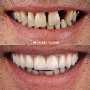 Descuento en implantología en Madrid - Implantes dentales baratos en Madrid