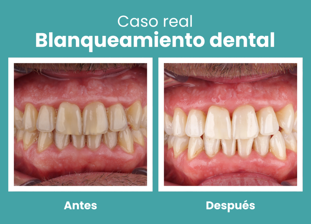 blanqueamiento dental antes y despues caso real