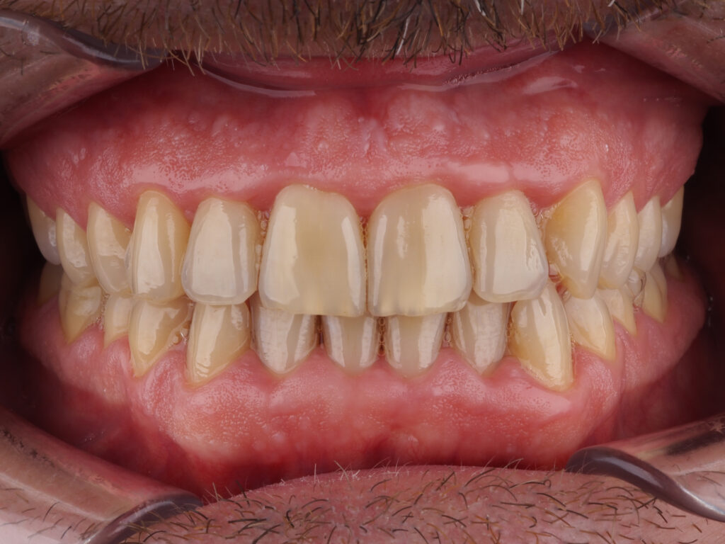 caso real de blanqueamiento dental