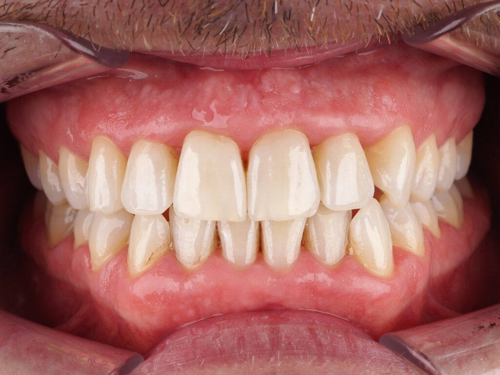 caso real de blanqueamiento dental