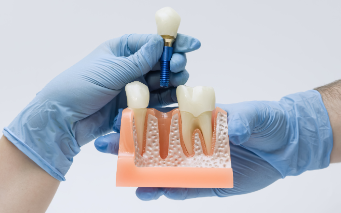 merece la pena ponerse un implante dental