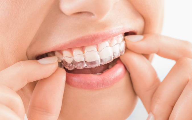 Invisalign antes y después