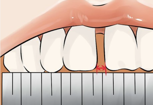 espacio entre dos dientes ante una molestia localizada