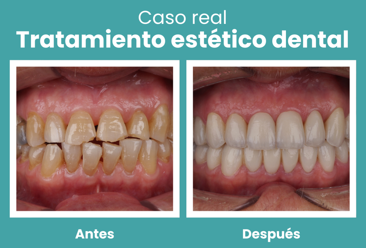 Tratamiento estético dental