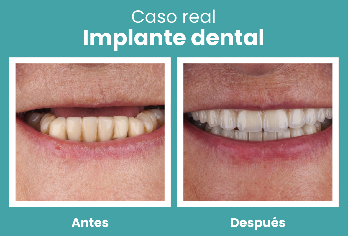 Cómo es el implante dental: paso a paso explicado de forma sencilla (caso real)