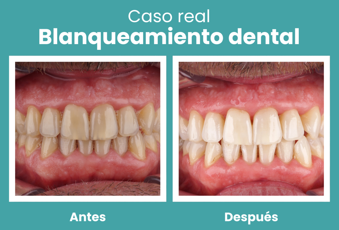 blanqueamiento dental antes y despues caso real