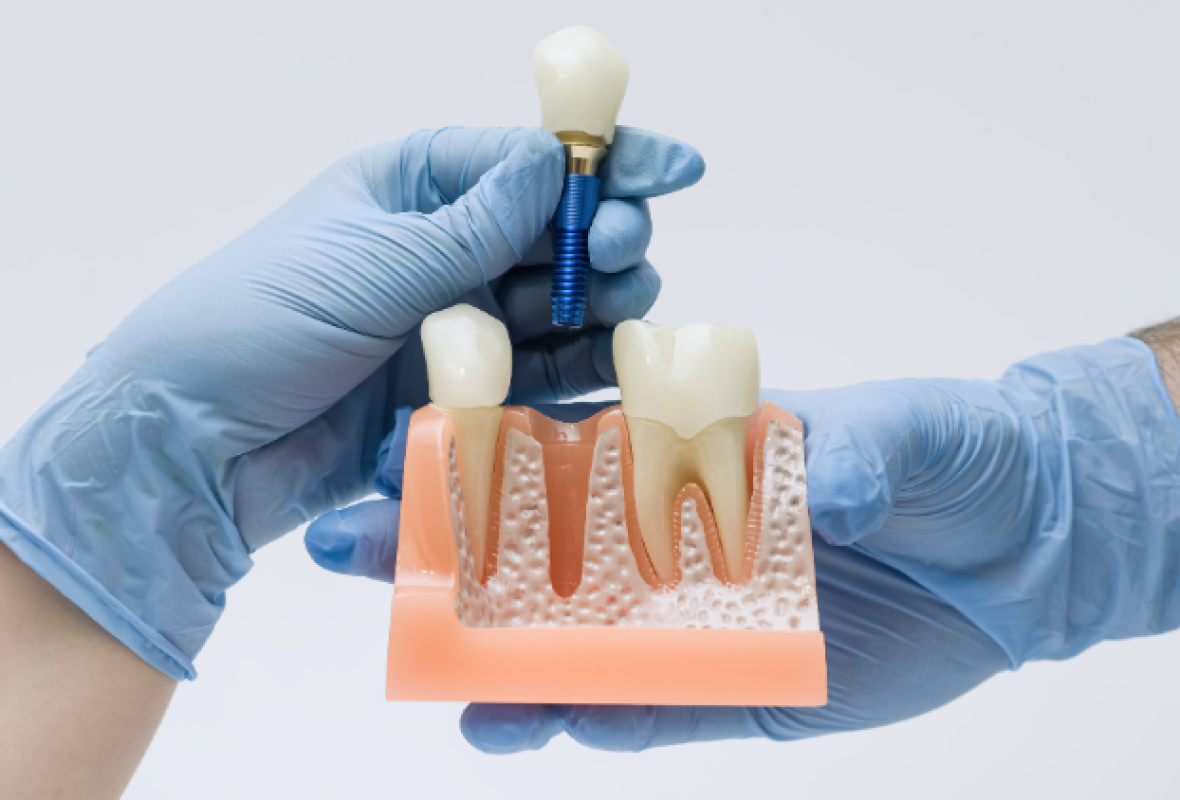 merece la pena ponerse un implante dental