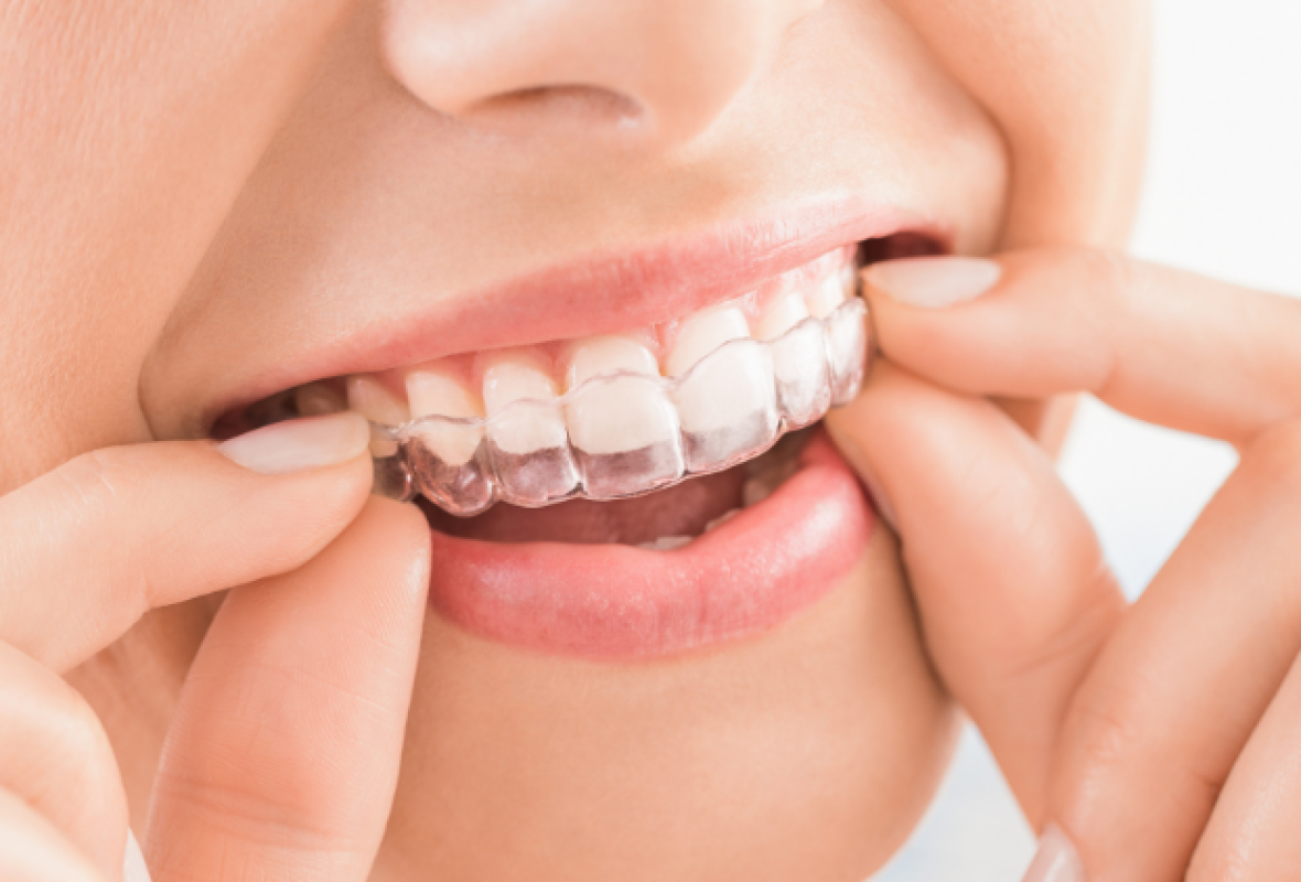 Invisalign antes y después