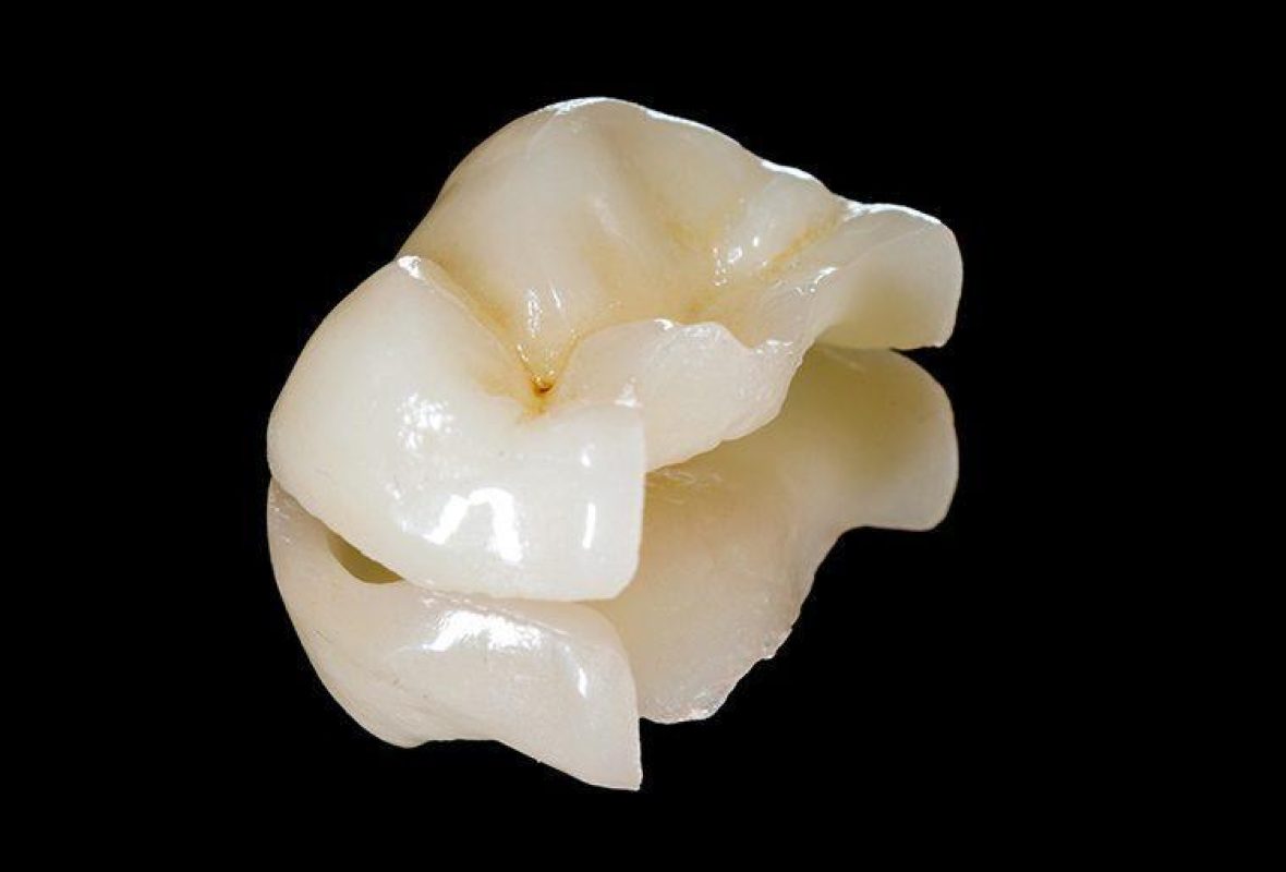 ¿Incrustación dental o corona?